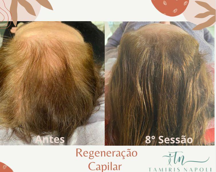 3-regeneracao-capilar.jpeg